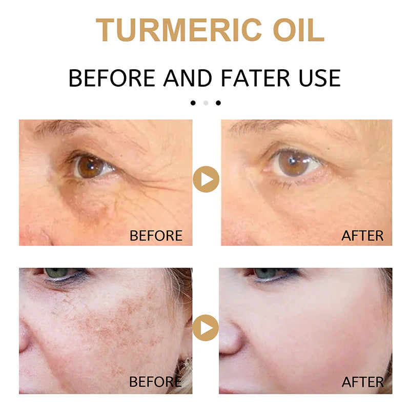 Turmeric Oil 30ml  Acne spots brightening whitening